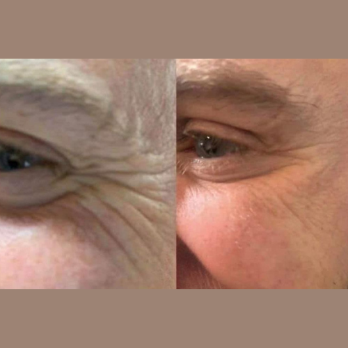 Botox Before & After